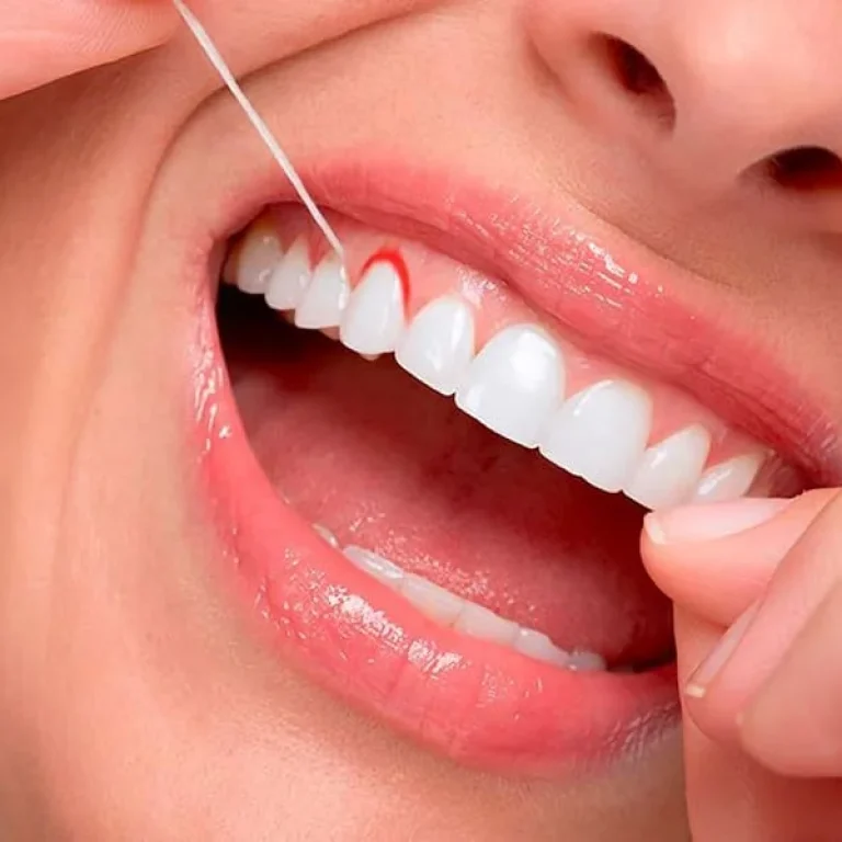 ¿Por qué me sangran las encías?